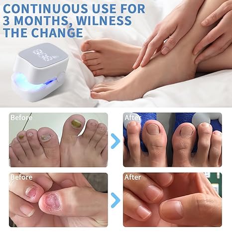 Hengulus Nail Fungus Treatment Light – Rechargeable Blue & Red Therapy Device